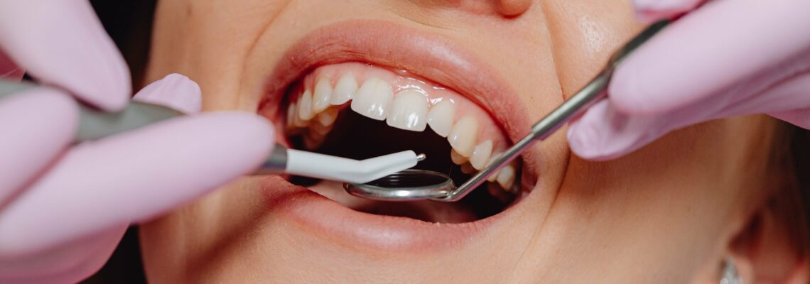 Comment se déroule le processus d’implantation dentaire ?